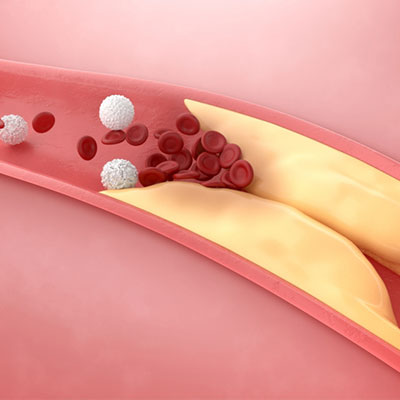 Cholesterol Control and Lipid Management in Vijayawada