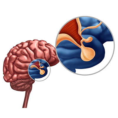 Pituitary Disorder Treatment in Vijayawada